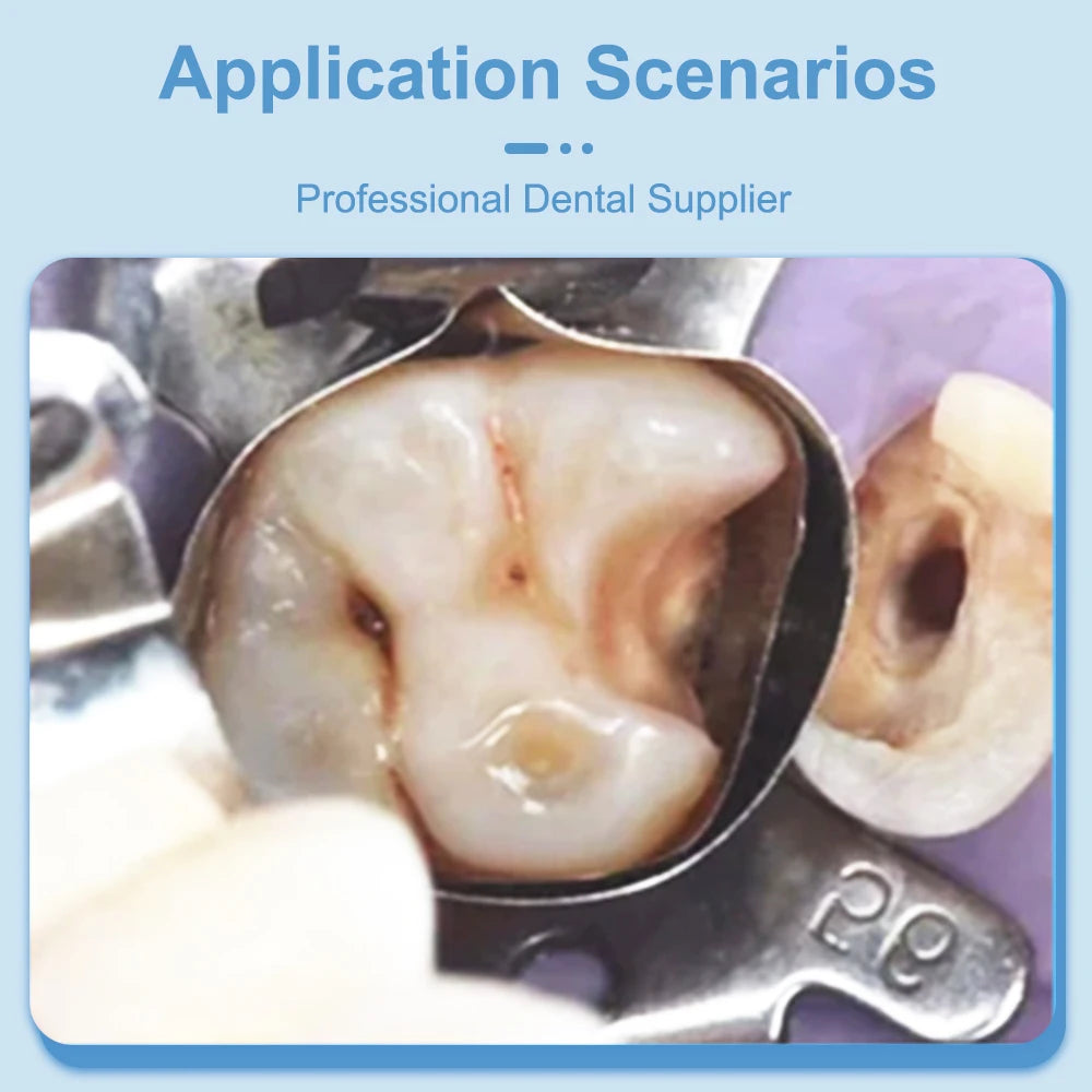 20Pcs Dental Matrix Bands Tofflemire Stuck Gingival Wall Lift Large Curvature Sectional Contoured Matrices Matrix Dentistry Tool Leedoar