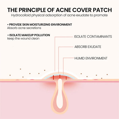 200 Patches Acne Patch Gentle Non-irritating Repair Facial Deep Cleansing Residue-Free Blemish Pimples Invisible Covering Patch Leedoar