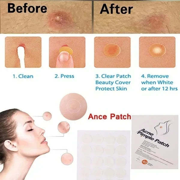 24 piezas de parches para eliminar puntos negros, acné, espinillas, pecas, cicatrices, tratamiento, pegatinas, mascarillas para el acné, cuidado de la piel facial 