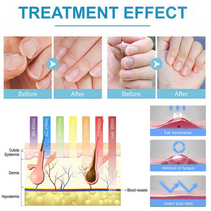 Fungal Nail Laser Repair Device Fast Nails Fungus Onychomycosis Repair Toenail Fingernail Removes Nail Fungus Foot Care Device Leedoar