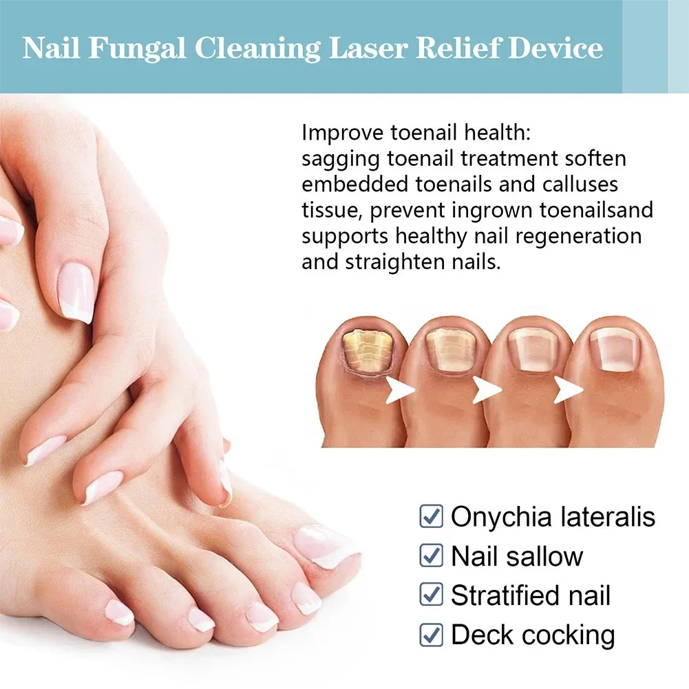 Fungal Nail Laser Repair Device Fast Nails Fungus Onychomycosis Repair Toenail Fingernail Removes Nail Fungus Foot Care Device Leedoar