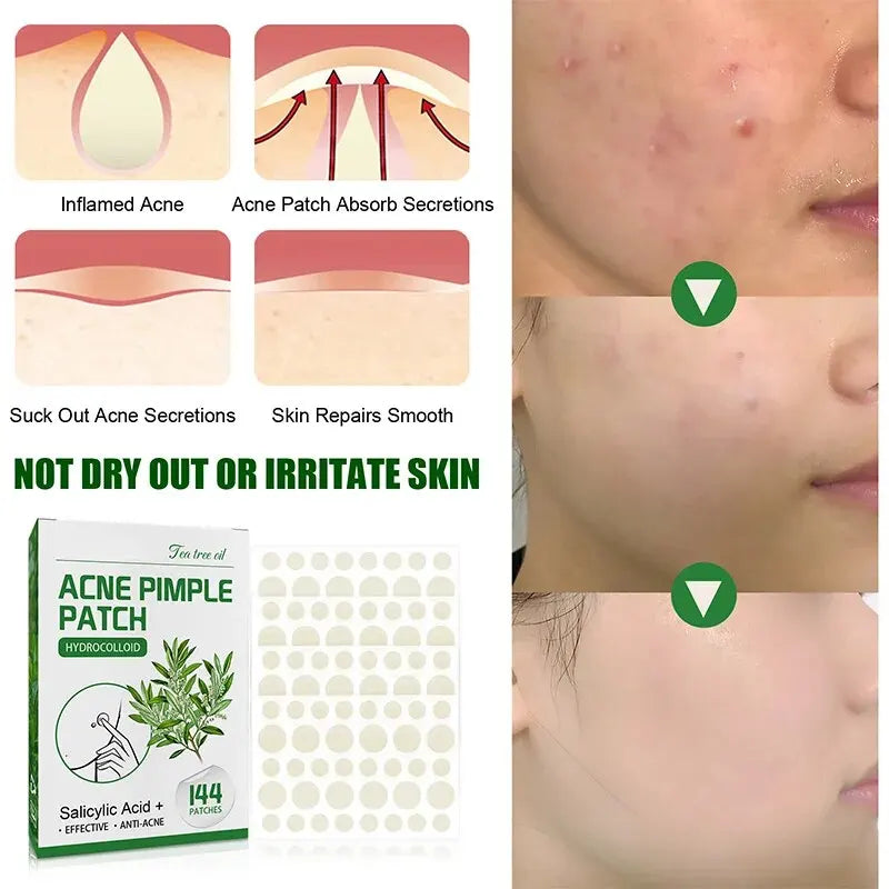 Adesivo invisível para espinhas, maquiagem invisível, adesivo para espinhas clareador, olheiras fechadas, acne, marcas de espinhas, à prova d'água, hidratante 